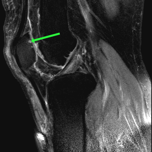 Patellofemoral Chondromalacia Proscan Education